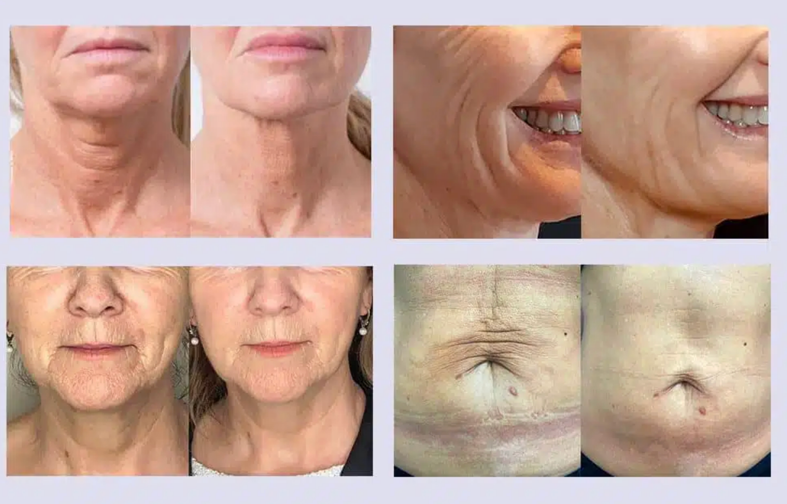 How Bio-remodelling Injections Can Transform Your Skin
