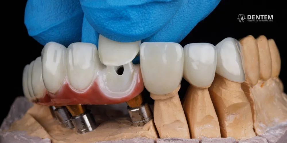 Dental Veneers: Transforming Smiles with Precision and Aesthetics