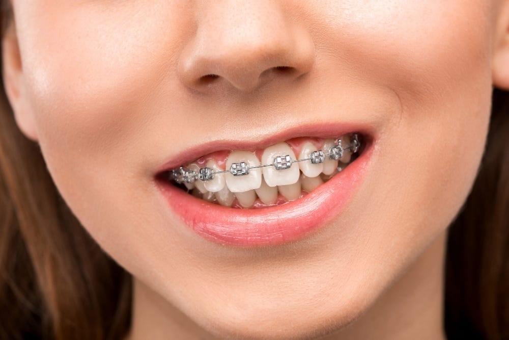 Transforming Smiles: Exploring the Influence of Orthodontics