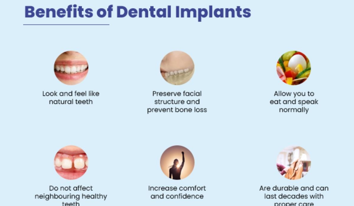The Benefits of Installing Dental Implants