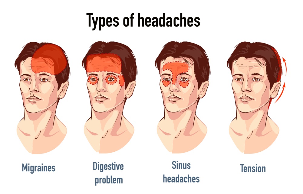 Understanding Different Types of Headaches and Their Triggers