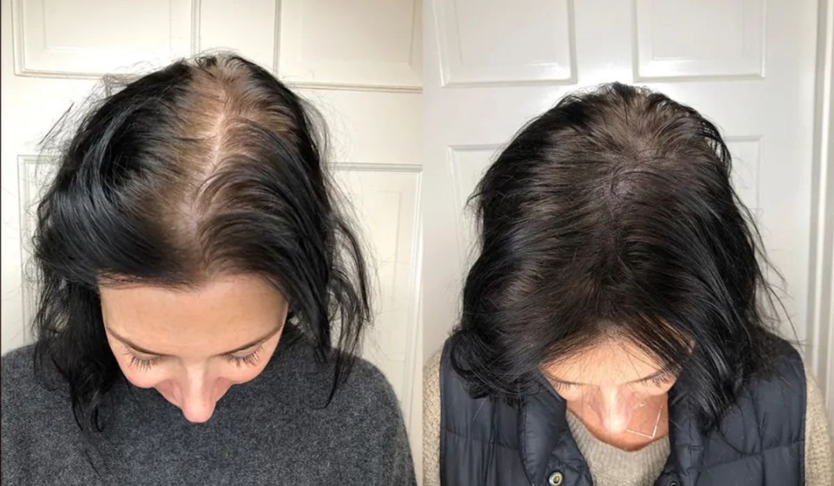 Five Specific Steps Exist To Sustain The Results Of Scalp Micropigmentation
