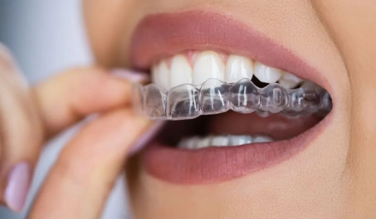 The Advantages of Clear Aligners