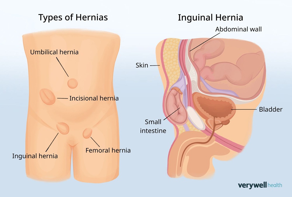 Understanding Different Types of Hernias and Their Treatments