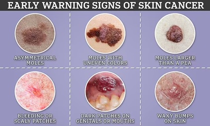 Common Warning Signs of Skin Cancer Everyone Should Know