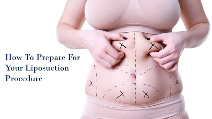 How to Prepare for Your Liposuction Procedure