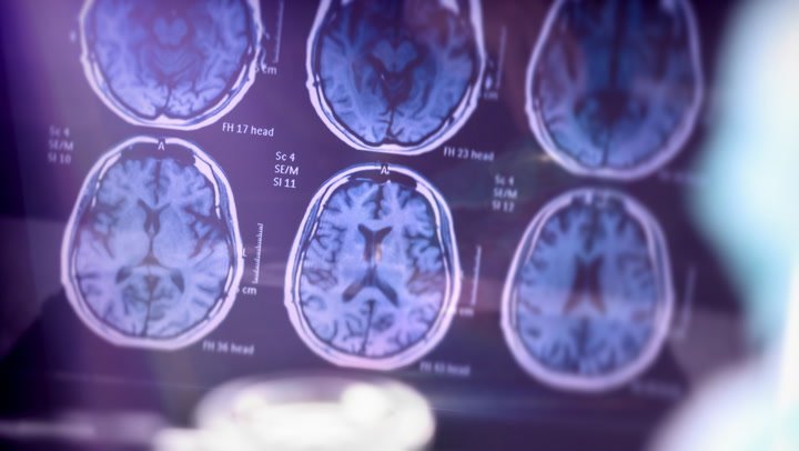 Signs of an Aging Brain That You Shouldn’t Ignore