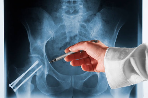Hip Fracture: Causes, Treatment and Recovery – Ultimate Guide
