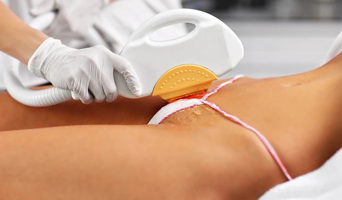 The Complete Guide to Brazilian Laser Hair Removal: Benefits, Comfort, and Results