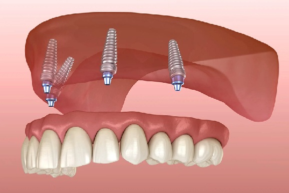 A Senior’s Guide to Affordable Dentures in Kyle, TX