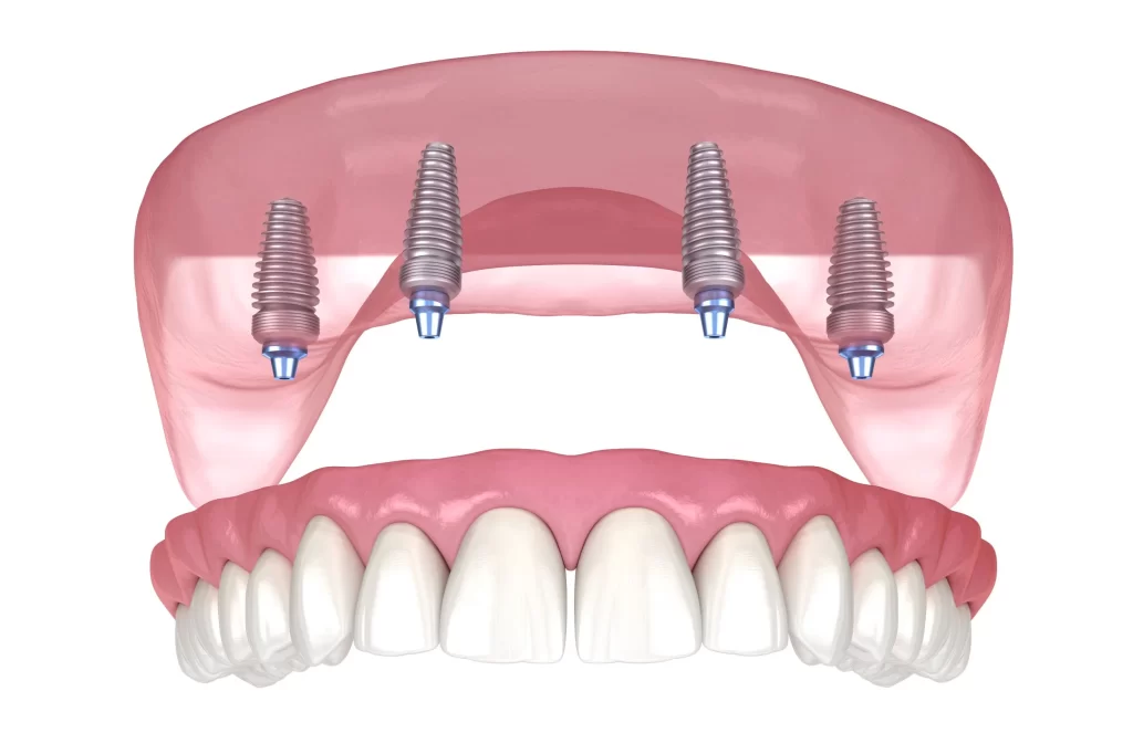 Dental Implants Hungary