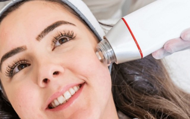 Is RF Microneedling Worth It? Results, Cost, and Recovery in Singapore